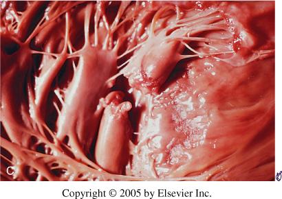 Papilláris izom ruptúra Incidencia: MI esetek kb. 1%-a Kisebb kiterjedésű infarktusokhoz társul Parciális vs.
