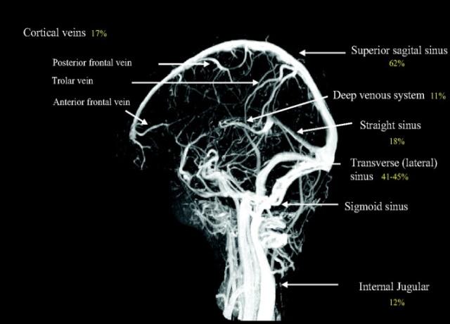 oedema hátterében Intracerebrális Vénás Hálózat