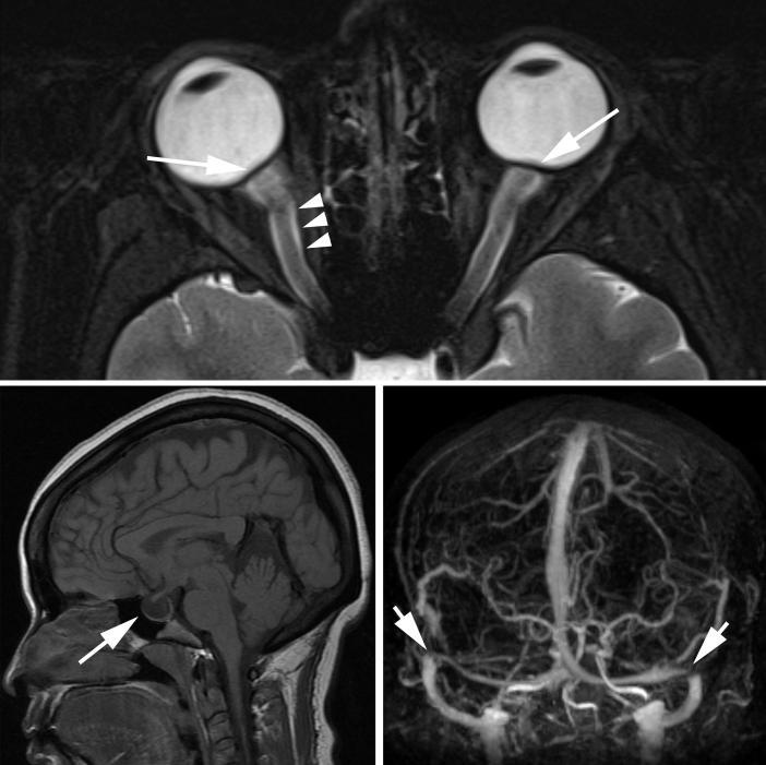 A NEURORADIOLOGIA jelentősége a papilla oedema háttér betegségének: IIH a kiderítésében CT-Venográfia: Menigeális infiltrációt, izodens tumorokat Nagyobb intracerebrális thrombosist MRI / MRI