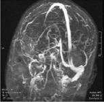 Hungarian Congress of Neuroradiology, Siofok, 2009 1./ tágult periopticus subarachnoidális tér (45%) 2./ promineáló papillák + a bulbusok hátsó pólusának belapulása (80%) 3./ empty sella (70%) 4.