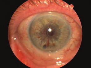 A szemészeti vizsgálatok jelentősége a cukorbeteg-gondozásban Összefoglaló közlemény lözhetetlen adat az olvasóképesség. A macula a retina centrális, éles látásért, pl.