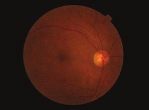 fogalmak. A diabeteses retinopathia bármely stádiumában kialakulhat maculopathia, amely a re- - - 4. táblázat.