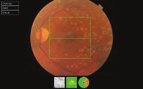 A szemészeti vizsgálatok jelentősége a cukorbeteg-gondozásban Összefoglaló közlemény ket okozó maculopathia.