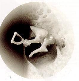 Dobüreg izületei Articulatio incudo-malleolaris Articulatio