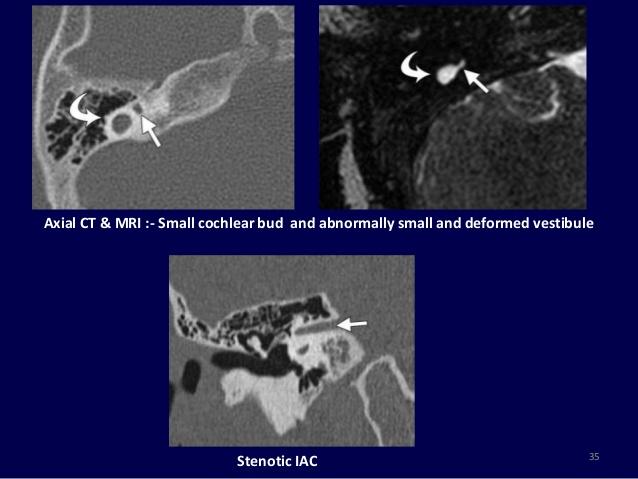 csökevényes cochlea malformált vestibulum és scc IAC csökevényes norm.