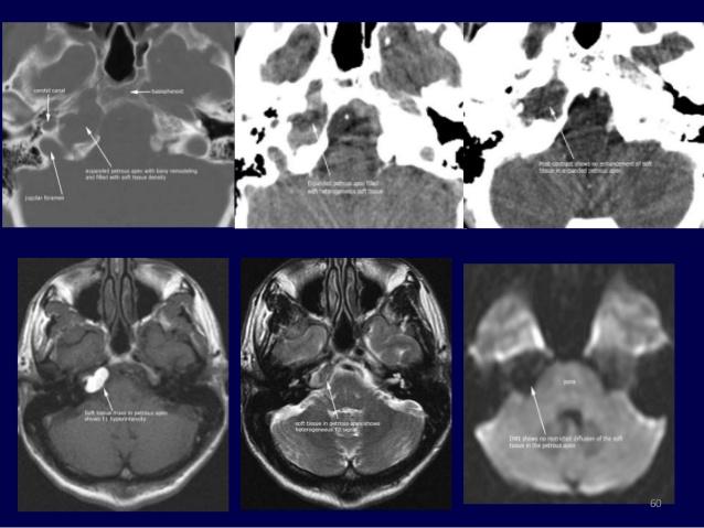 pyogen gyulladás után labyrinthus elcsontosodik Cholesteatoma komplikációval Cholesterol granuloma Petrosus apicitis gyulladt, lezárt légsejtek Cholesteatoma