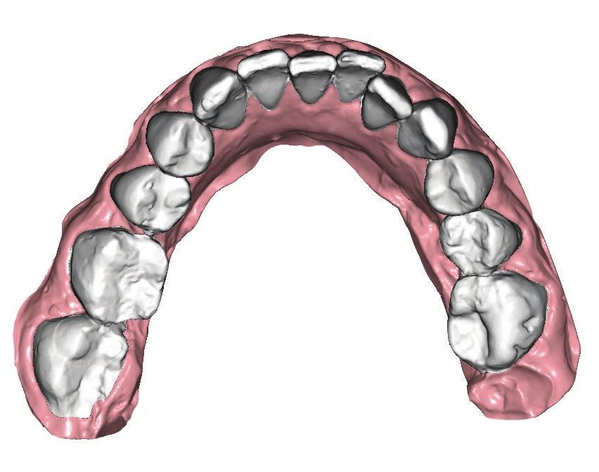A legtöbb fogorvos kisebb korrekciók esetén alkalmazza a láthatatlan fogszabályozót és a páciensek is ezzel keresik meg orvosukat, ilyenek a leggyakoribb frontfog torlódás, és diasthemák a front