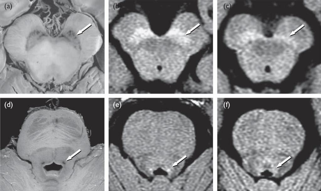 Agytörzsi monoaminerg központok vizualizálása emberben (neuromelanin-szenzitív MRI)