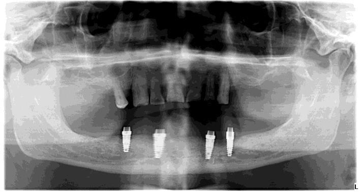 Teljes alsó foghiány ellátása négy