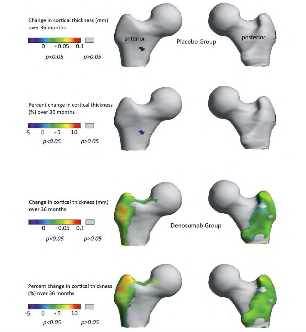 3 éves kezelés hatása corticalis vastagságra Freedom -3D csontdenzitás növekedés - femur QCT analízis 5.4% -9.