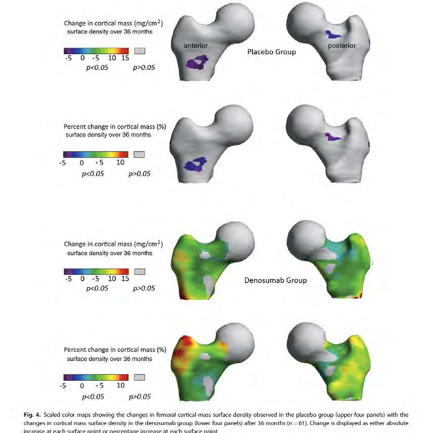 The largest relative increase in thickness was found in the lateral greater trochanter (up to 12%) at the insertion site of the gluteal muscles.