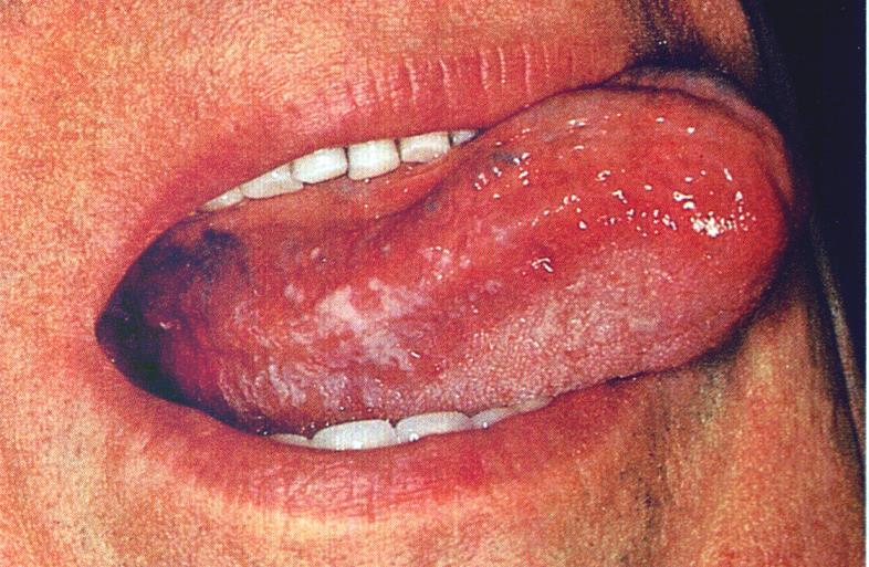 Mononucleosis Kaposi sarcoma