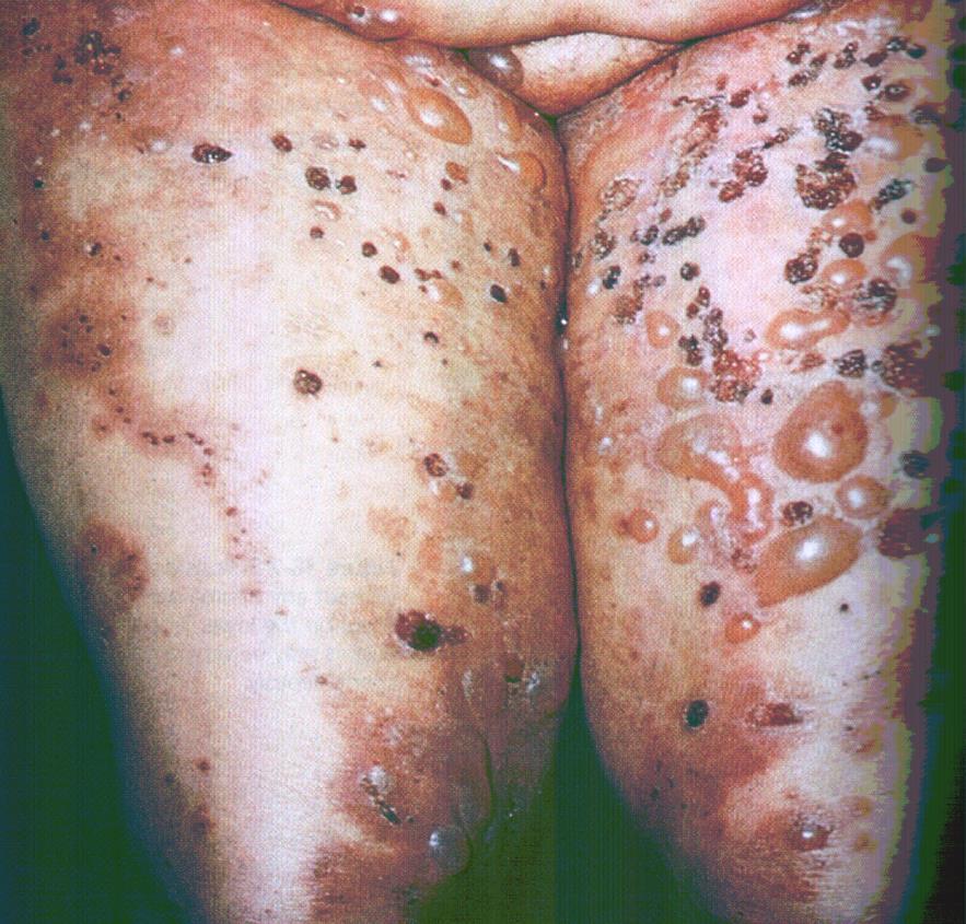Bőr pemphigus A dermatológiai Pemphigusos betegek 88%-ának vannak