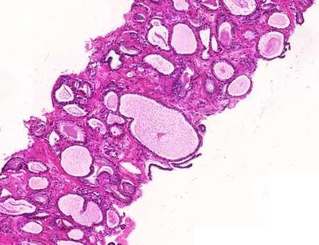 Microcystic carcinoma Deceptively benign