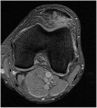 Trochlear dysplasia (96%)/patella alta(ok) Quadriceps ín distalis