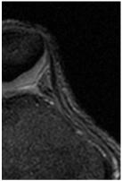 retinaculum (MPFL)