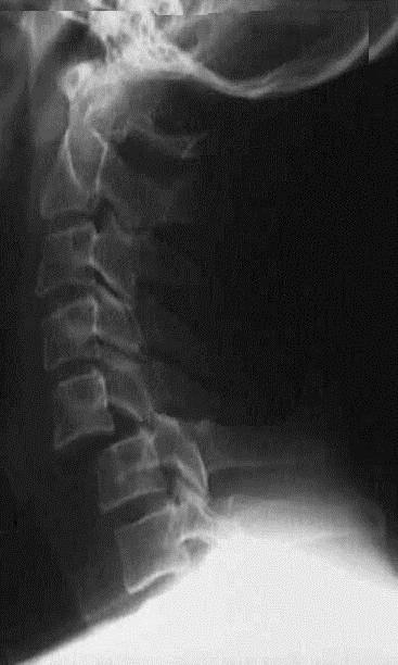 Gerincsérülések gyermekkorban 70%-a craniocervicalis átmenetben A sérülések