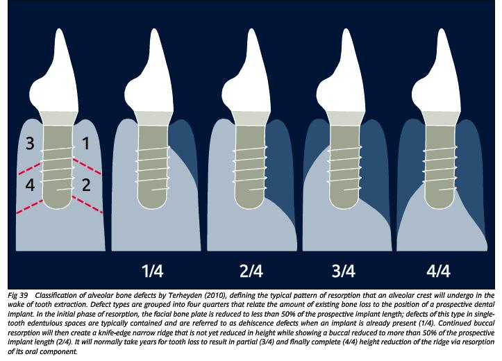 Bevezetés (Irodalmi háttér) A processus alveolaris csontállományát fenntartó inger az a rágóerőből adódó fiziológiás, funkcionális terhelés, melyet a fogak a periodontális ligamentumok által