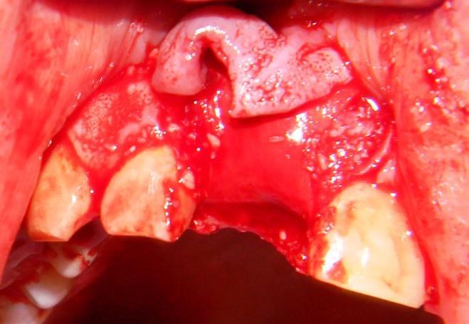 Az alveolus prezerváció műtéti technikái Az irodalomban az alveolus prezerváció számos technikájának leírását megtaláljuk. Számos bioanyag használható alveolus prezerváció céljából.