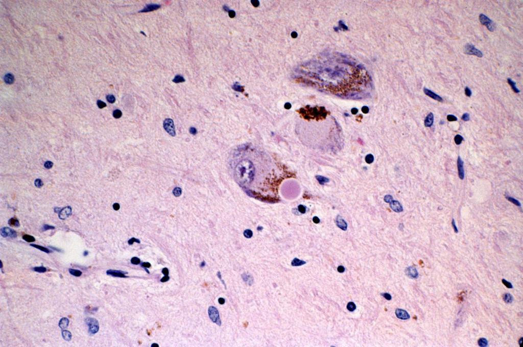 FM: a pigmentált neuronok pusztulása, a megmaradtakban a melanintartalom, a