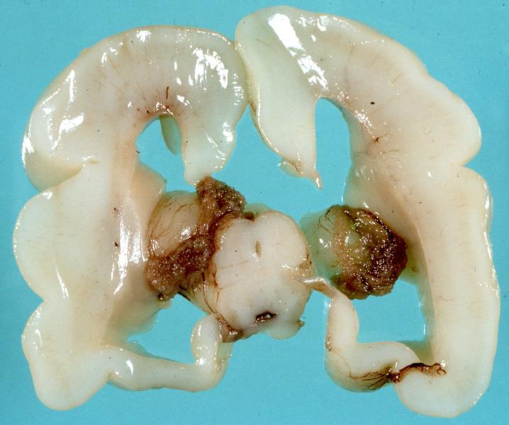 Corpus callosum agenesia Dr.