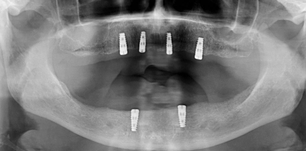 állcsont 12 pozícióban: Ø 3,8 mm 11,5 mm 22