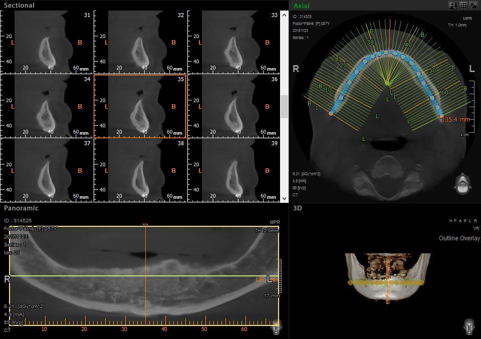 CBCT