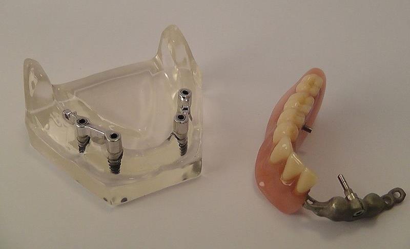 Kezelési terv - Felső állcsont Overdenture típusú pótlás Fix rész: 4 db implantátumon