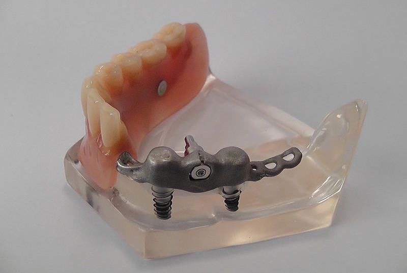 megtámasztású, merev elhorgonyzású overdenture, patkó alakban redukált fém alaplemezzel,