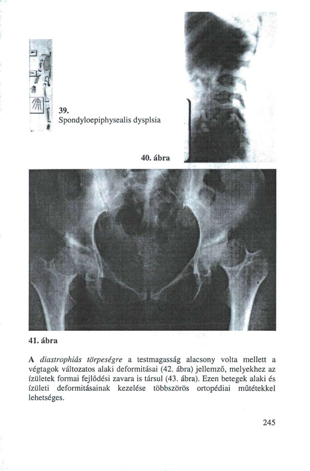 41. ábra A dicistrophiás törpeségre a testmagasság alacsony volta mellett a végtagok változatos alaki deformitásai (42.