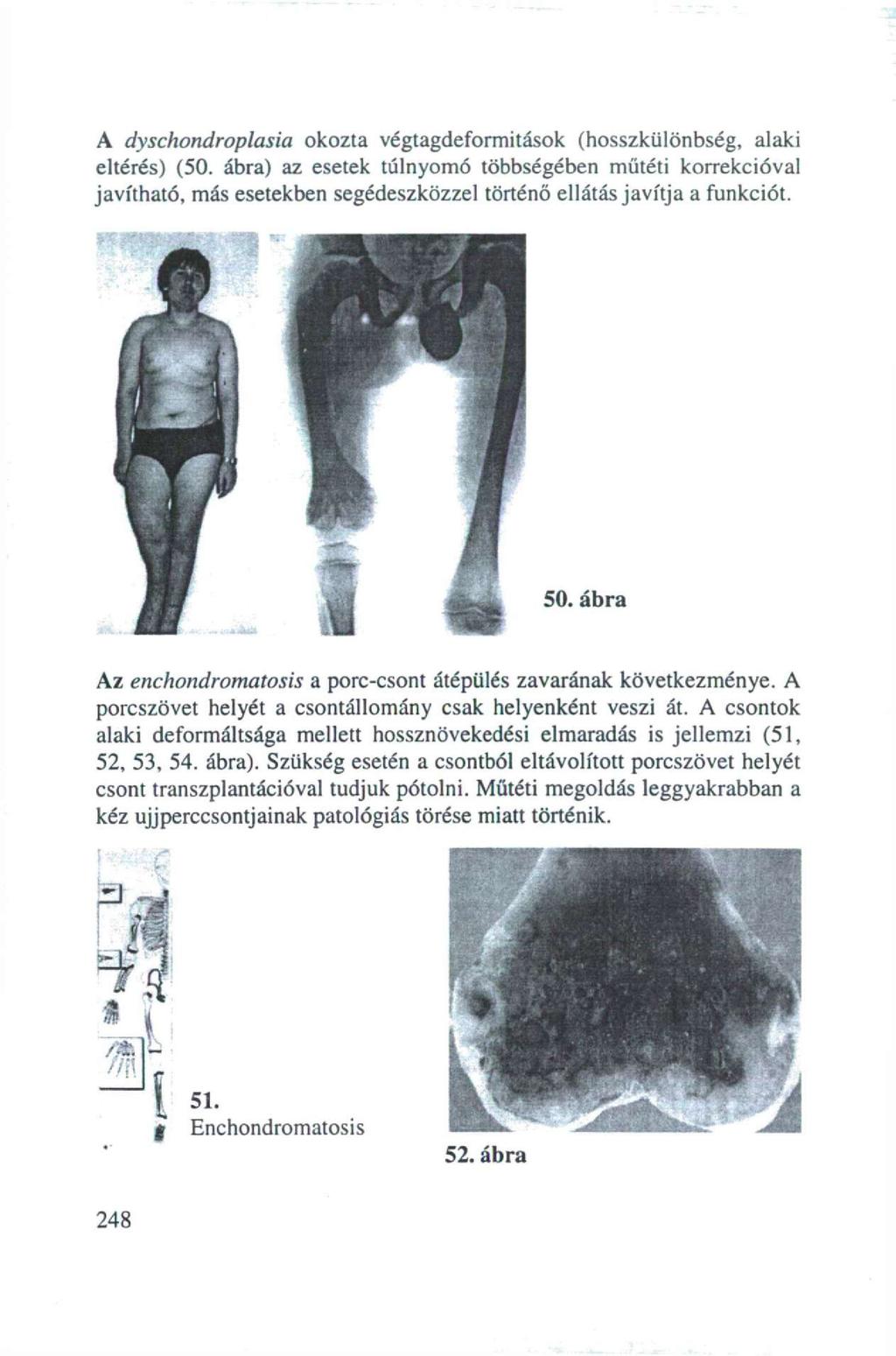 A dyschondroplasia okozta végtagdeformitások (hosszküiönbség, alaki eltérés) (50.