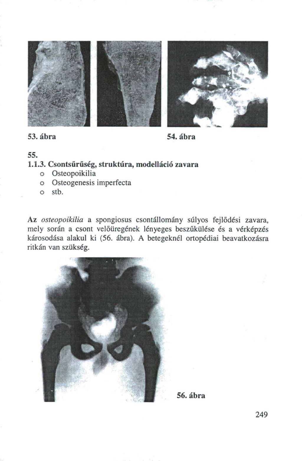 53. ábra 54. ábra 55. 1.1.3. Csontsűrűség, struktúra, modelláció zavara o Osteopoikilia o Osteogenesis imperfecta o stb.