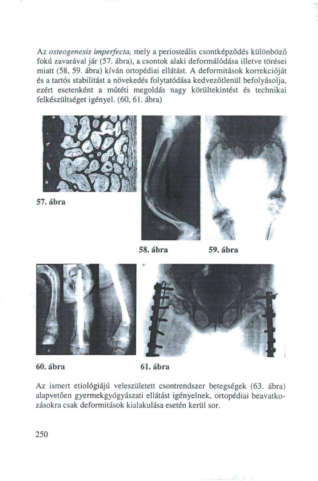 Az osteogenesis imperfecta, mely a periosteális csontképződés különböző fokú zavarával jár (57. ábra), a csontok alaki deformálódása illetve törései miatt (58, 59. ábra) kíván ortopédiai ellátást.