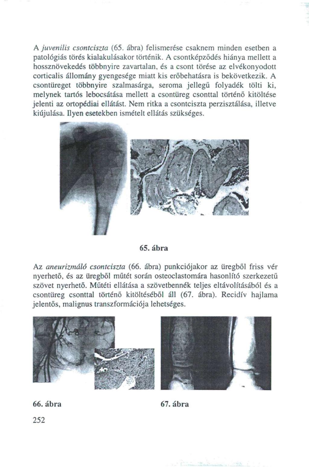 A juvenilis csontciszta (65. ábra) felismerése csaknem minden esetben a patológiás törés kialakulásakor történik.