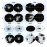 LÁTÁSVESZTÉS - kivizsgálási algoritmusa chiasma retrochiasmalis látóideg szakasz ONOCULARIS BINOCULARIS NEURITIS macula betegség Centro - coecalis scotoma ko.