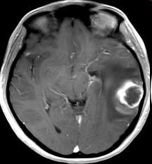 OEDEMA lokalizált generalizált - vénás elfolyás akadályozott - hypalbuminaemia - nyirokkeringés gátolt - jobb szívfél elégtelenség - gyulladás - Rh (ABO) incompatibilitás, fertőzés