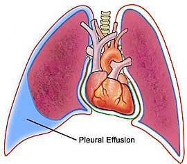 - cyanosis - congestiv gastritis,