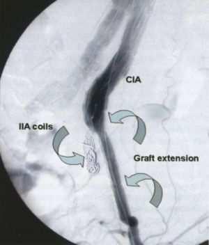 10 4. ábra. Az endoleak megoldása: az endoprothesis bal szárának meghosszabbítása stenttel és az a. iliaca interna embolizálása. A II. és III.