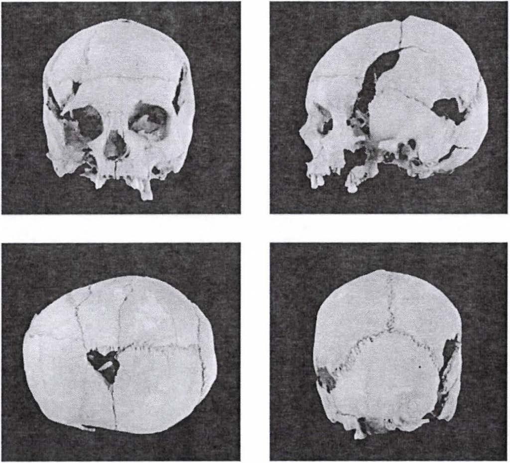 3. ábra: Az 539. sírban nyugvó adultus korú nő koponyája. Figure 3: The skull of an adult female buried in grave No. 539. 4.