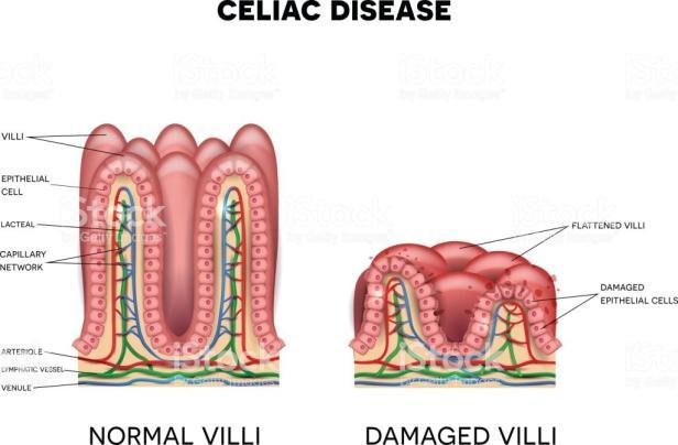 Glutén szenzitív enteropathia coeliakia a lakosság 1%-át érinti Genetikai adottság HLADQ2,Q8 + kalászos gabonák glutén fehérjéinek autoimmun jellegu betegség, amelynek során a glutén hatására a