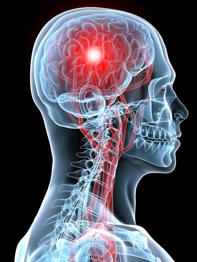 EXTRACELLULÁRIS VEZIKULÁK ÉS A STROKE ISCHAEMIÁS