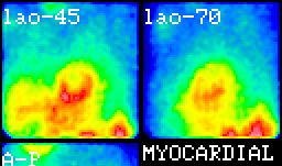 Szívizom perfúzió (vérátfolyás) Szívizom perfúzió (vérátfolyás) bal kamra jobb kamra tüdő Goris Watson féle háttér levonás d a y 1 x 1 x 2 b máj lép A bal