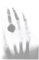 A RADIOAKTIVITÁS FÖLFEDEZÉSE Röntgen 1895 X-sugárzás felfedezése. Becqerel 1896 Urániumsók foszforenciájának vizsgálata Úgy tapasztalta, hogy ha a sókat napsugárzás érte röntgen sugárzás keletkezett.