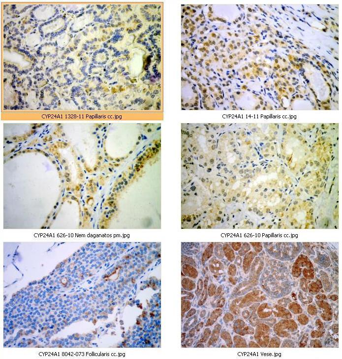 CYP24A1 expresszió pm tumorokban A CYP24A1 fokozott expressziója differenciált pajzsmirigy tumorokban!