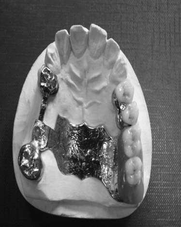 Merevítőrudas elhorgonyzás sorközi foghiány esetén: Elhorgonyozza a részleges lemezes fogpótlást Pillérfogakat sínezi Dentális megtámasztásban részt