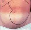 CML clinical