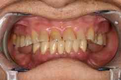 pótolható -maradék fogak száma 1 vagy
