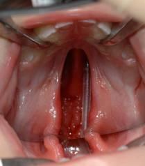 A hasadék folytatódik a szájüregben, hasadt a fogmedernyúlvány, a kemény- és a lágyszájpad.