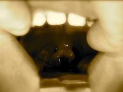 Uvula bifida Csökevényes szájpadhasadék forma. Egyedül a nyelvcsap fejlődése nem tökéletes.