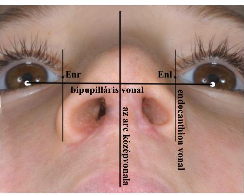 0 Ecset eszközének segítségével). 17. ábra Extranazális antropometriai jellemzők. Pu r : jobb pupilla inferior, Pu l : bal pupilla inferior, En r : jobb endocanthion, En l : bal endocanthion 18.